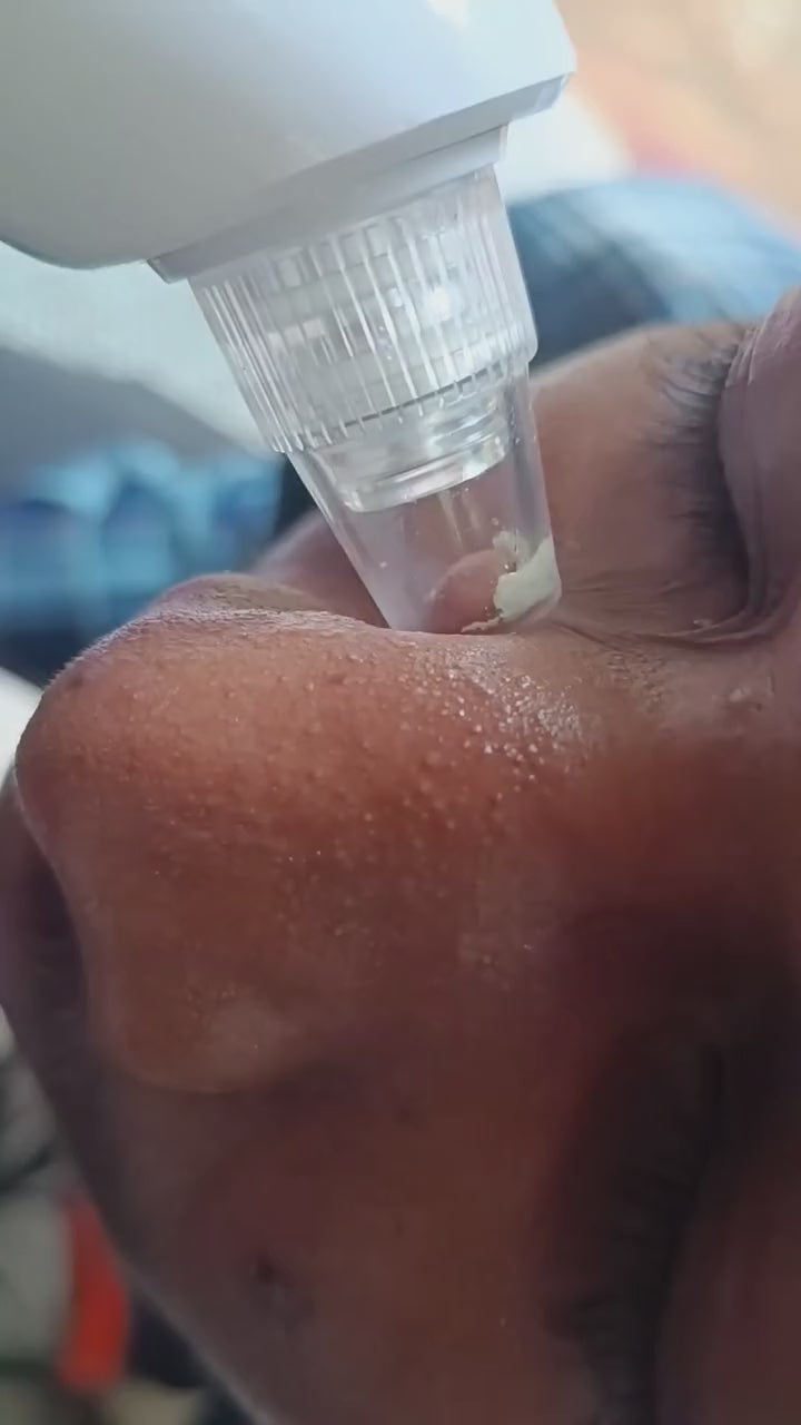 Electric Blackhead Remover